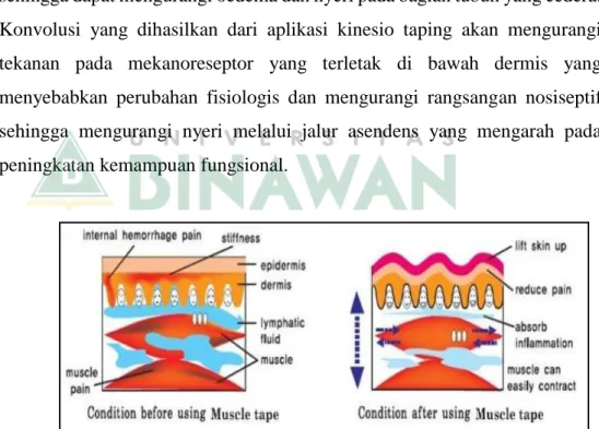 Gambar 2.3 a Mekanisme Kinesio Taping Pada Area Cedera 