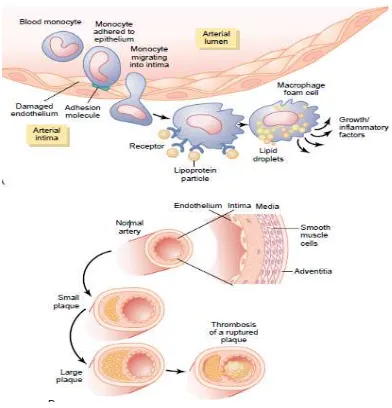 Gambar 2.3 Perkembangan plak ateroskerosis 