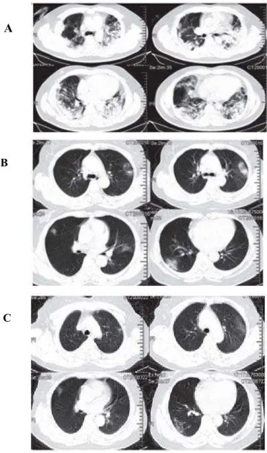 Gambar 6. Gambaran CT Scan Toraks pasien pneumonia COVID-19 di Wuhan,                     Tiongkok