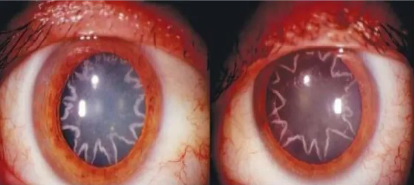 Gambar 2.5. Star-Shaped Cataracts. 20