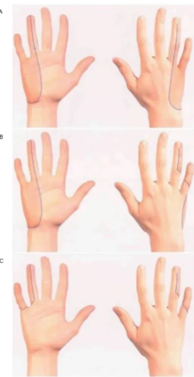 Fig. 46 The approximate areas within which sensory changes may be found in lesions of the ulnar nerve: A above the origin of the dorsal cutaneous branch, B below the origin of the dorsal cutaneous branch and above the origin of the palmar branch, C below t