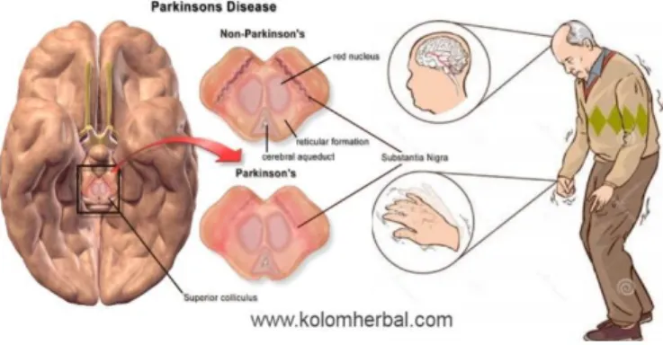 Gambar 5. Penyebab penyakit parkinson 