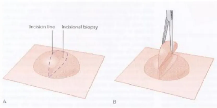 Gambar 17.  Biopsi Insisional  b.  Biopsi eksisional 