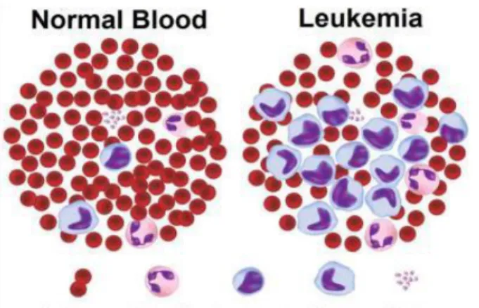 Gambar 5.1 Perbedaan gambaran darah normal dan leukemia (CMS, 2018) Tabel 5.1 Perbedaan Leukemia Akut dan Kronik Karakteristik Leukemia Akut Leukemia Kronik