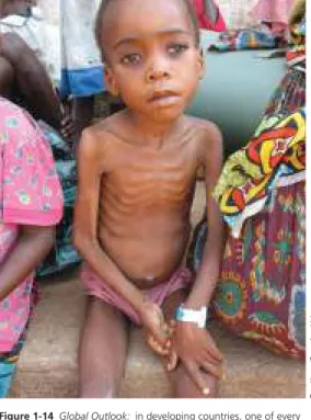 Figure 1-14 Global Outlook:  in developing countries, one of every  three children under age 5, such as this child in Lunda, Angola,  suffers from severe malnutrition caused by a lack of calories and  protein