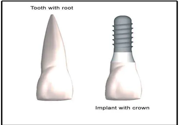 Gambar 1. Implan menyerupai gigi asli.(Taylor T. D,and Laney. W.R. Dental Implant.<http://dentalimplants.uchc.edu/about/index