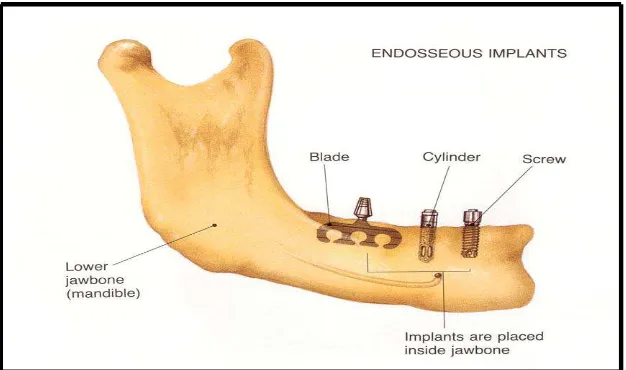 Gambar 4. Implan endosteal. (Taylor T. D,and Laney. W. R. Dental Implant<http://dentalimplants.uchc.edu/about/types.html> ) 