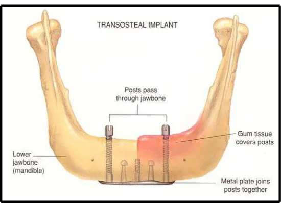 Gambar 5. Implan transosteal. (Taylor T. D,and Laney. W. R. Dental Implant.<http://dentalimplants.uchc.edu/images/about_implants/image_page21_transosteal.jpg>) 