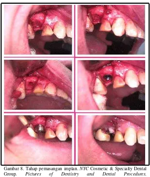 Gambar 8. Tahap pemasangan implan. NYC <http://www.nycdentist.com/dental-photo-detail/1691/116/110/single-Cosmetic & Specialty Dental Group