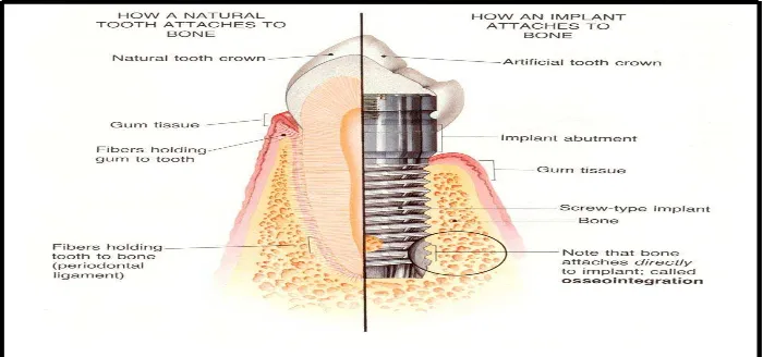 Gambar 9. Proses osseointegrasi. (Taylor T. D,and Laney. W. R. Dental Implant<http://dentalimplants.uchc.edu/images/about_implants/image_page23_boneconnectio n.jpg>)