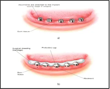 Gambar 10  a) Pemasangan abutment connection b) Mukosa sekitar abutment ditutupi dengan pembalut periodontal  yang dihubungkan melalui protective cap