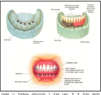 Gambar 11. Pembuatan protesa.Taylor T. D,and Laney. W. R. Dental Implant <http://dentalimplants.uchc.edu/about/restorative.html >) 