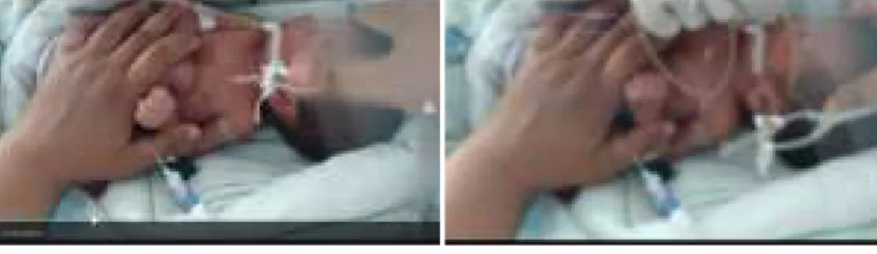 Figure 13.1  Hand - Position During Four-Handed Suctioning