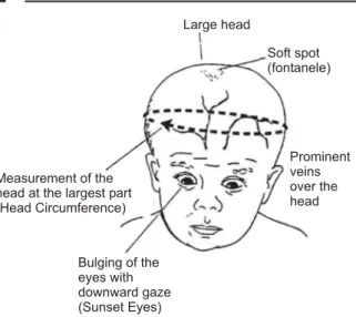 Fig. 4.1: Hydrocephaly (See Pl. 21)
