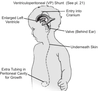 Fig. 4.2: Child with ventricular peritoneal shunt 