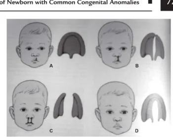 Fig. 4.3: Types of cleft lip and cleft palate The above illustration shows the four variations of  cleft lip and cleft palate.