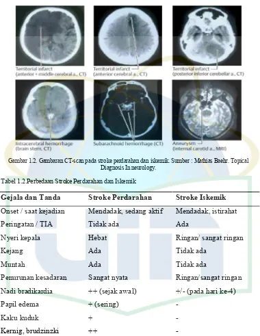 Gambar 1.2. Gambaran CT-scan pada stroke perdarahan dan iskemik. Sumber : Mathias Baehr