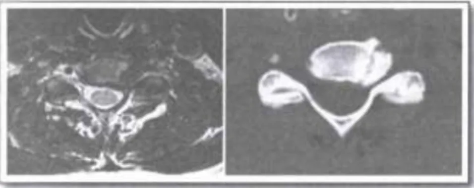 Gambar 7.5 Gambaran MRI (kiri) dan CT scan (kanan) pada pasien dengan radikulopati C6