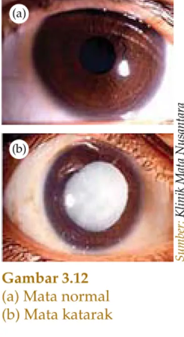 Gambar 3.12 (a) Mata normal (b) Mata katarak