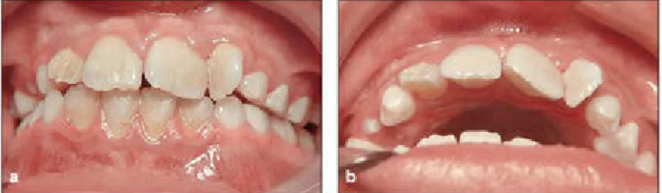 Fig 4-1 (a and b) Bolton discrepancy (oversized maxillary incisors).