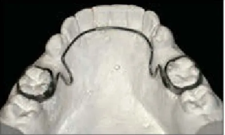 Fig  4-5 Lower  holding  arch.  The  inclusion  of  two  U-loops,  mesial  to  the  left  and  right  bands, allows minor adjustment.