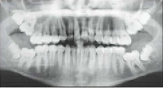 Fig 4-27 Molar crowding that is unsuitable for first molar distalization because of severe crowding in the second and third molars.