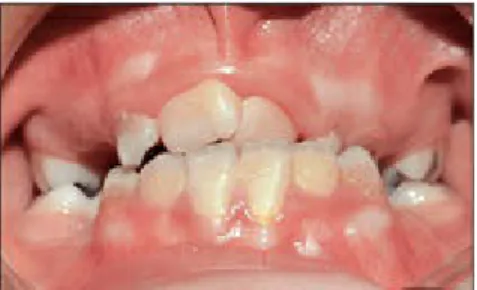 Fig 1-1 Maxillary arch collapse.