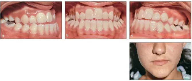 Fig 1-3 (a to d) Asymmetric mandibular growth.