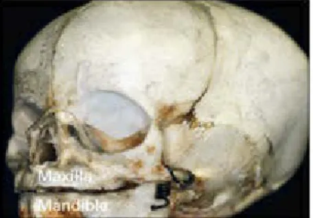 Fig 2-21 Newborn skull showing the jaws’ basal bone as part of the gum pads.