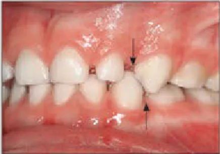 Fig 2-22 Maxillary and mandibular primate spaces (arrows) in the primary dentition.