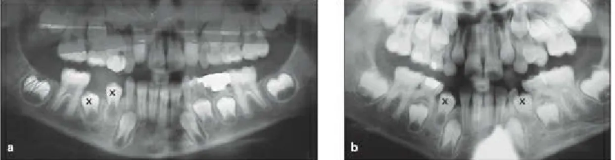 Fig  2-24 (a) Panoramic  radiograph  of  a  7-year-old  child  whose  primary  right  molars  have  been lost  due  to  long  abscess