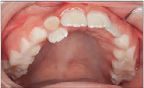 Fig  2-26 Abnormal  path  of  eruption  of  the  permanent  lateral  incisor  and  overretained  primary lateral incisor.