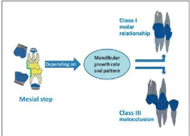 Fig 2-28 Mesial step terminal plane in the primary dentition. The permanent molars may develop a Class I molar relationship or, if mandibular growth is excessive, a Class III malocclusion.