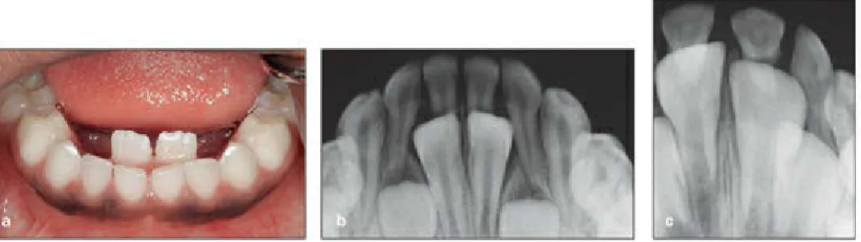 Fig 2-31 (a to c) Delayed resorption of the primary central incisor roots, causing lingual eruption of the mandibular permanent central incisors.