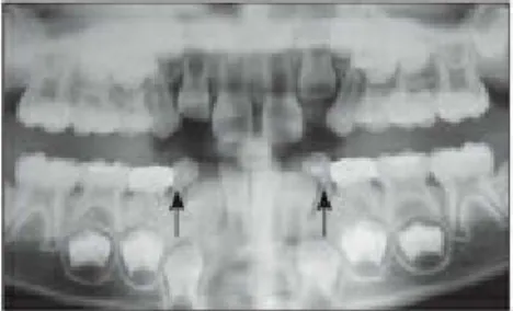 Fig  2-32 Mandibular  lateral  incisor  eruption  causing  crescent-shaped  resorption (arrows) of  the primary canine roots.