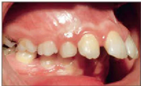 Fig 2-36 Severe maxillary incisor protrusion. These teeth are prone to fracture and require early intervention.