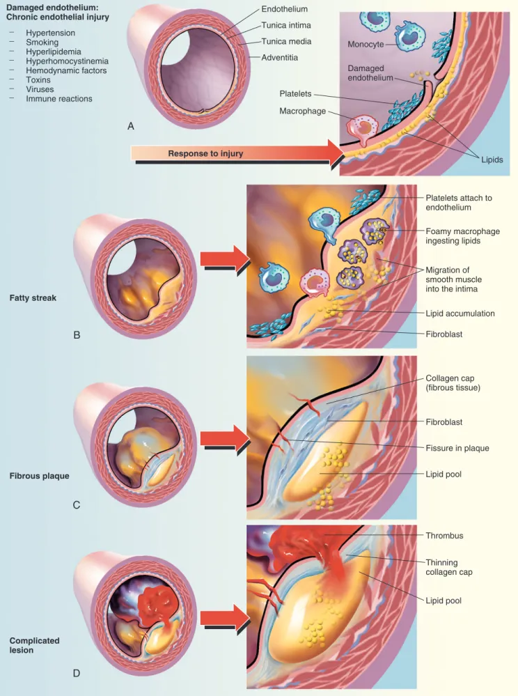Fig. 50.2  ■ Progression of atherosclerosis.