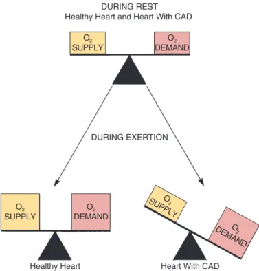 Fig. 51.1  ■ Effect of exertion on the balance between oxygen  supply and oxygen demand in the healthy heart and the  heart with CAD.