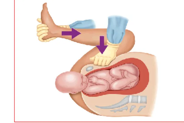 Gambar 2. Distosia Bahu        Gambar 3. Perasat McRobert’s 