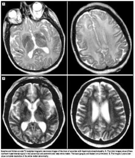 Gambar 4. MRI pada Penderita Hashimoto’s Encephalopathy 