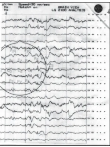 Gambar 6. EEG menunjukkan gelombang lambat difus dengan gelombang paku 