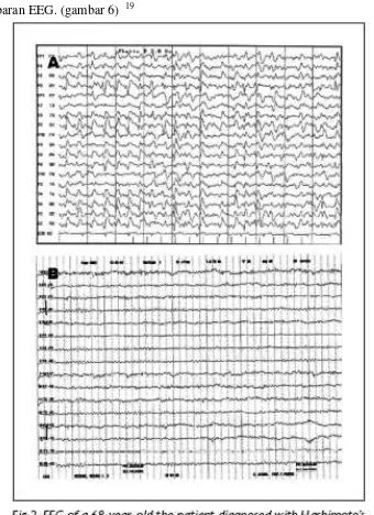 gambaran EEG. (gambar 6)  19 