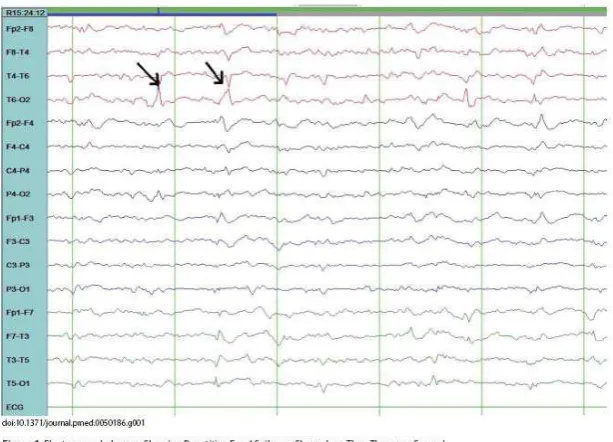 Gambar 8. EEG menunjukkan gelombang tajam dan paku  