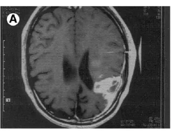 Gambar 16. Gliosarcoma pada T1W Dikutip dari : Johnson M, Powell SZ, Boyer PJ, et al. Dural Lesions Mimicking Meningiomas.Human Pathology.2002
