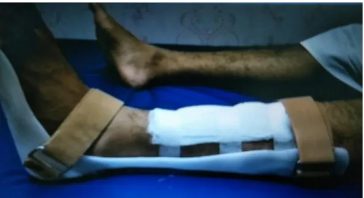 Figure 1: Isometric Exercise Plantar Flexor 