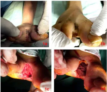 Figure  1:  A,  B)  Clinical  manifestation  of  interdigital  malignant  melanoma cutaneous metastases; C) Postoperative results after the  second excision of a primary tumour, followed again with secondary  healing;  D)  Surgical  excision  of  the  inte
