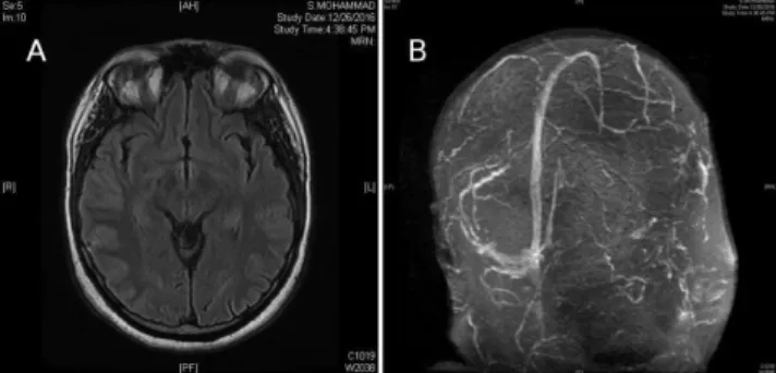 Figure  1:  A)  Normal  MRI  brain  Axial  FLAIR;  B)  MRV  showing  absent  flow  in  the  right  transverse,  sigmoid,  and  right  internal  jugular vein suggestive of cerebral venous thrombosis 