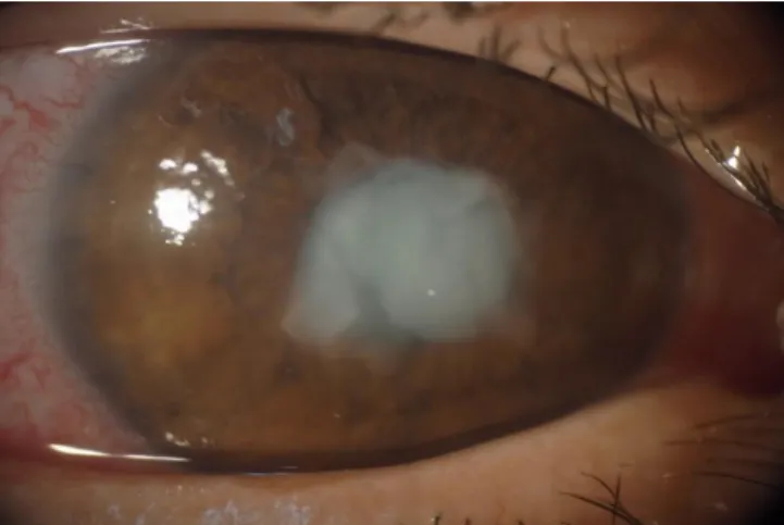 Figure 1: Anterior lens capsule rupture on diffuse light 