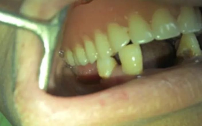 Figure  2:  Super  eruption  of  the  frontal  teeth  and  mandibular  ridge  resorption 