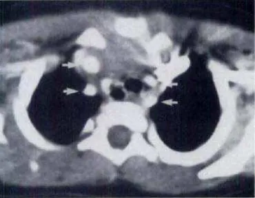 Gambar 7. CT scan pada arkus aorta kanan dengan arteri subklavia kiri menyimpang. 